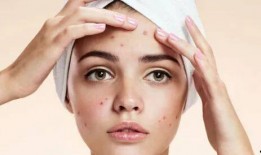 长痘痘吃土瓜,痘痘肌肤的天然食疗秘籍