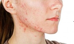 长痘痘吃土瓜,痘痘肌肤的天然食疗秘籍